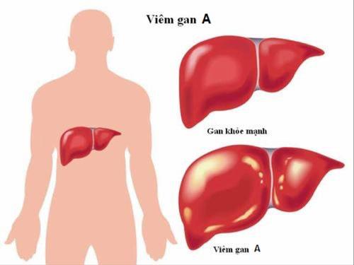 Tìm hiểu về bệnh viêm gan A và cách phòng ngừa