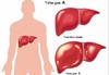 Tìm hiểu về bệnh viêm gan A và cách phòng ngừa